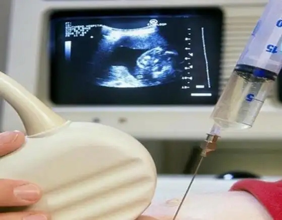 The Importance of Amniocentesis in Older Pregnant Women